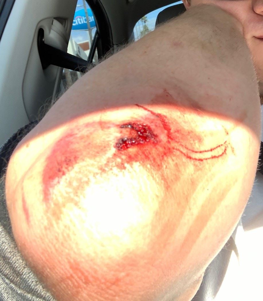Scooter accident injury to elbow requiring stitches and surgery